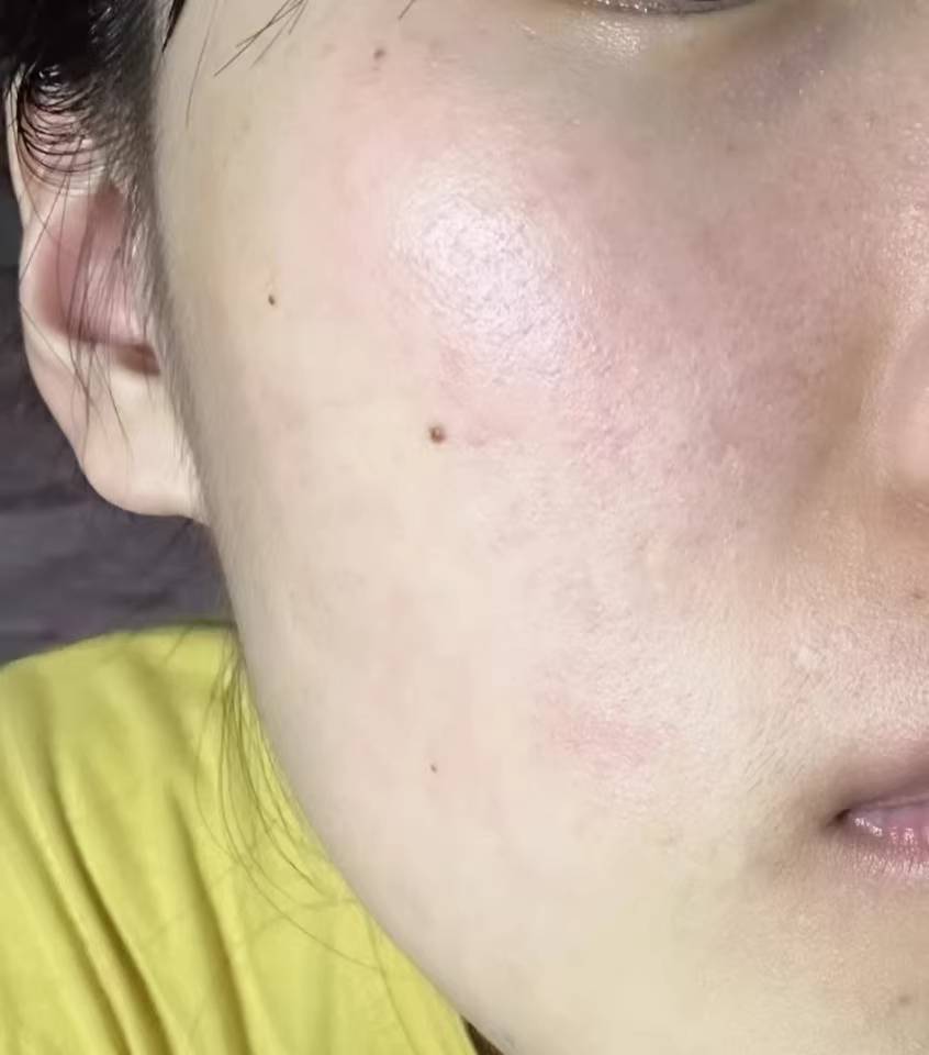 去痘产品有那些?